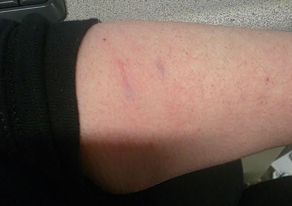 forearm with bite bruses