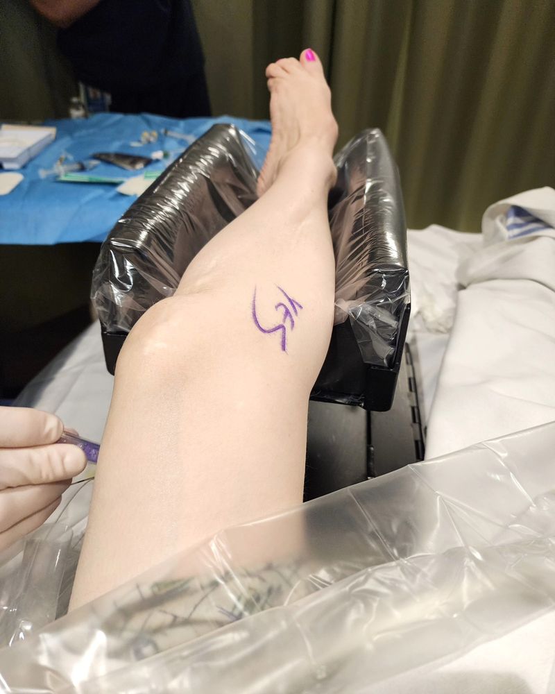 Photo shows a left leg during a pre-op popliteal nerve block insertion. 