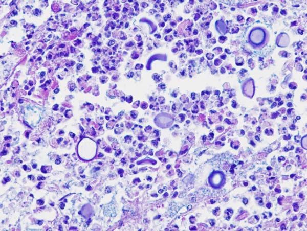 Imatge histopatològica de criptococcosi pulmonar en un pacient immunodeprimit. Tinció Blau Alcià-PAS.

KGH (Wikimedia Commons, CC BY-SA 3.0)