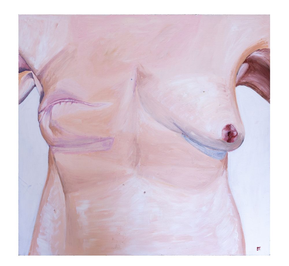 Acrylic painting of a woman's torso with a mastectomy scar on her right side