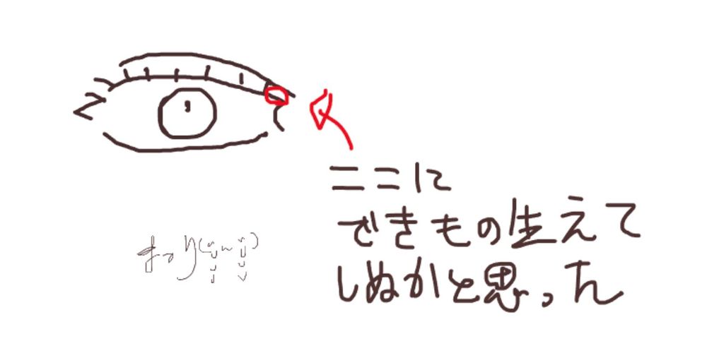 まぶたのはしっこにできもの生えてしぬかと思った