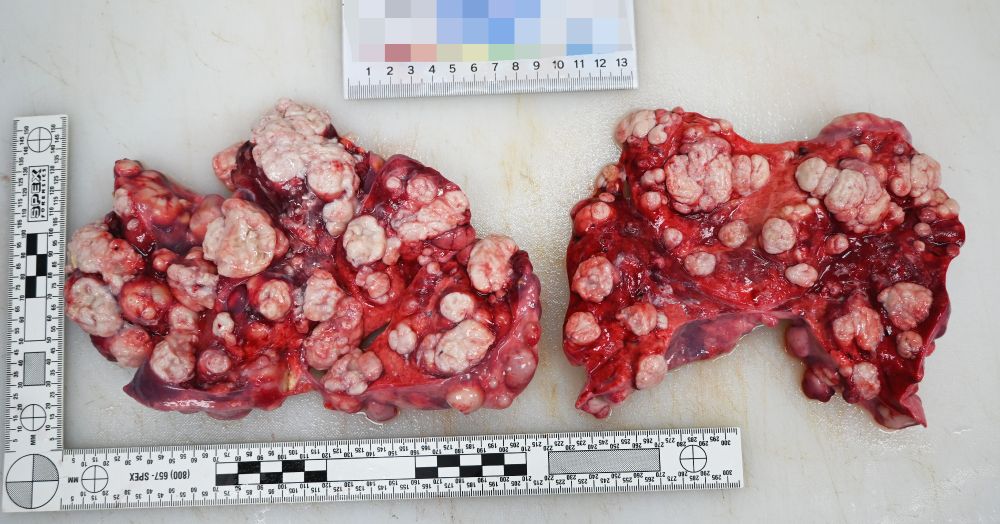 diffuse lung metastases 