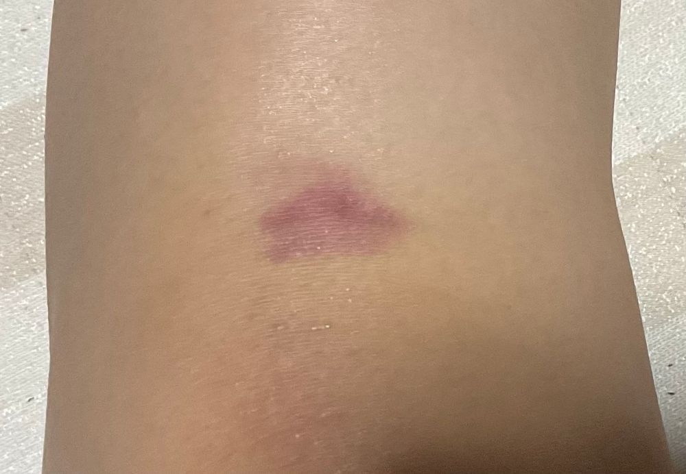 左膝の打ち身(大きめ)