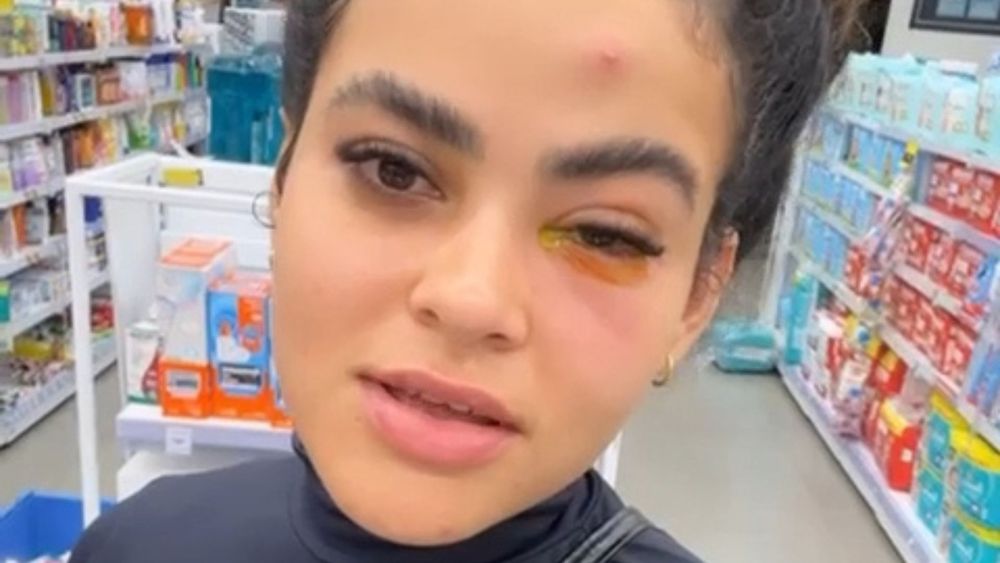 Infecção no olho por mosca de banheiro: influenciadora conta experiência