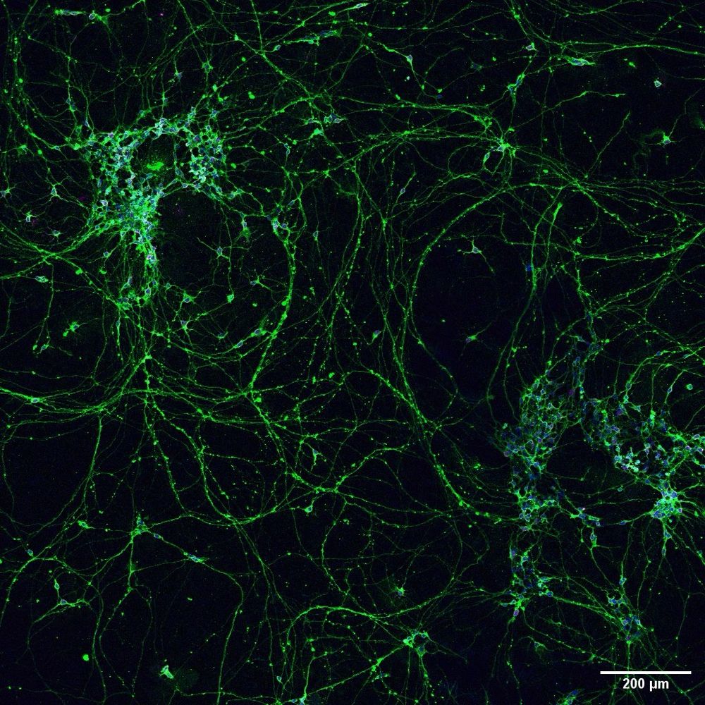 Image of human stem cell derived retinal ganglion cells in culture. 
Green = beta-3-tubulin, neural marker
Magenta = gamma synuclein
Blue = nuclei