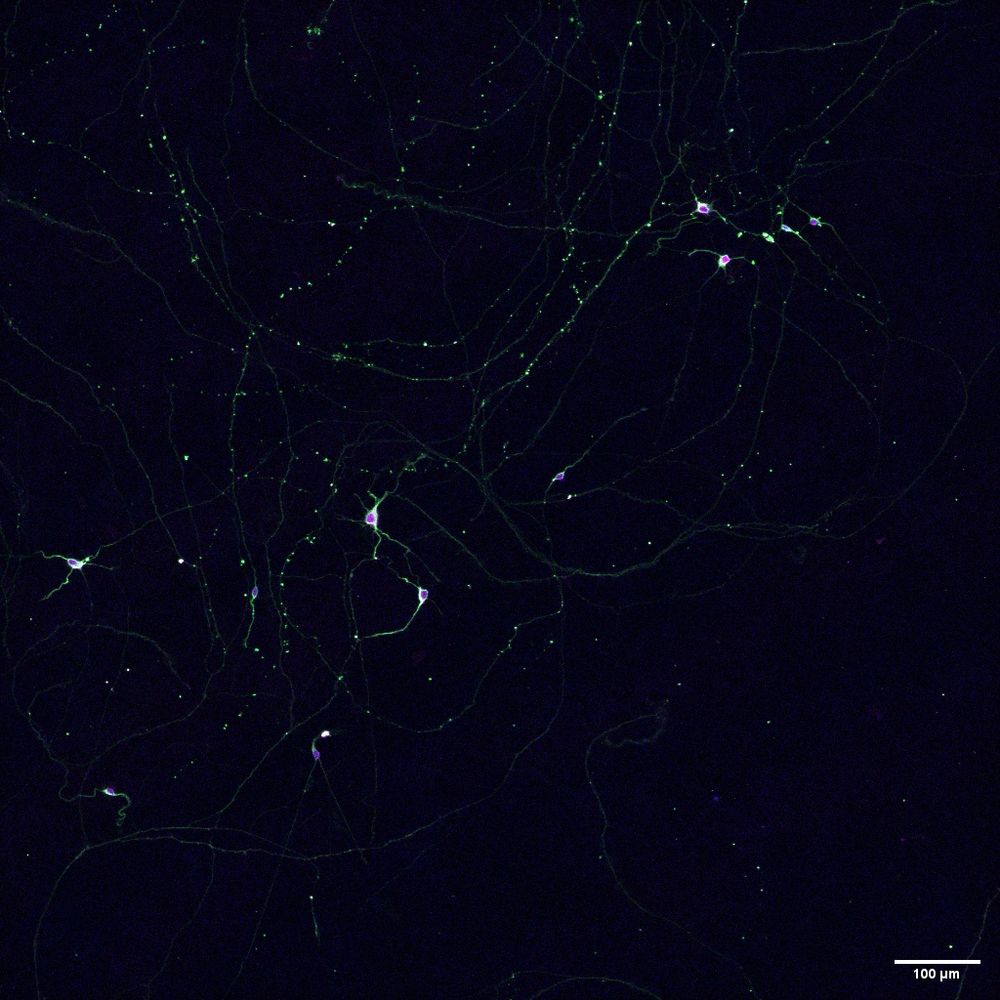 Stem cell-derived retinal ganglion cells. Green = B-3-tubulin, red + blue = nuclear markers. Low seeding density to examine networking capacity - look at the size of those neurites! We aren’t yet sure what the green speckles (varicosities?) in the neurites are - questions, questions. 
Taken at 10X magnification.