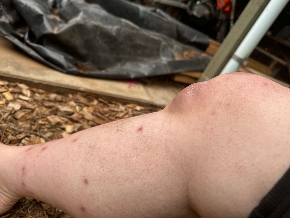 Badly brusied kneecap with haematoma side veiw looks like two lumps or two kneecaps 