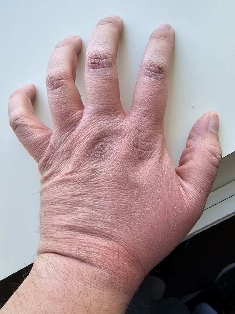 My hand which is red, dried, flaking, and has been bleeding.