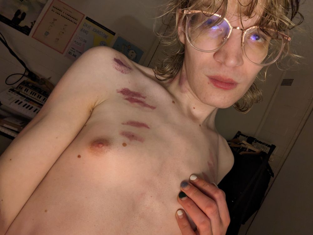 A selfie of a woman with lots of hickeys on her chest and she looks like she had a good time 