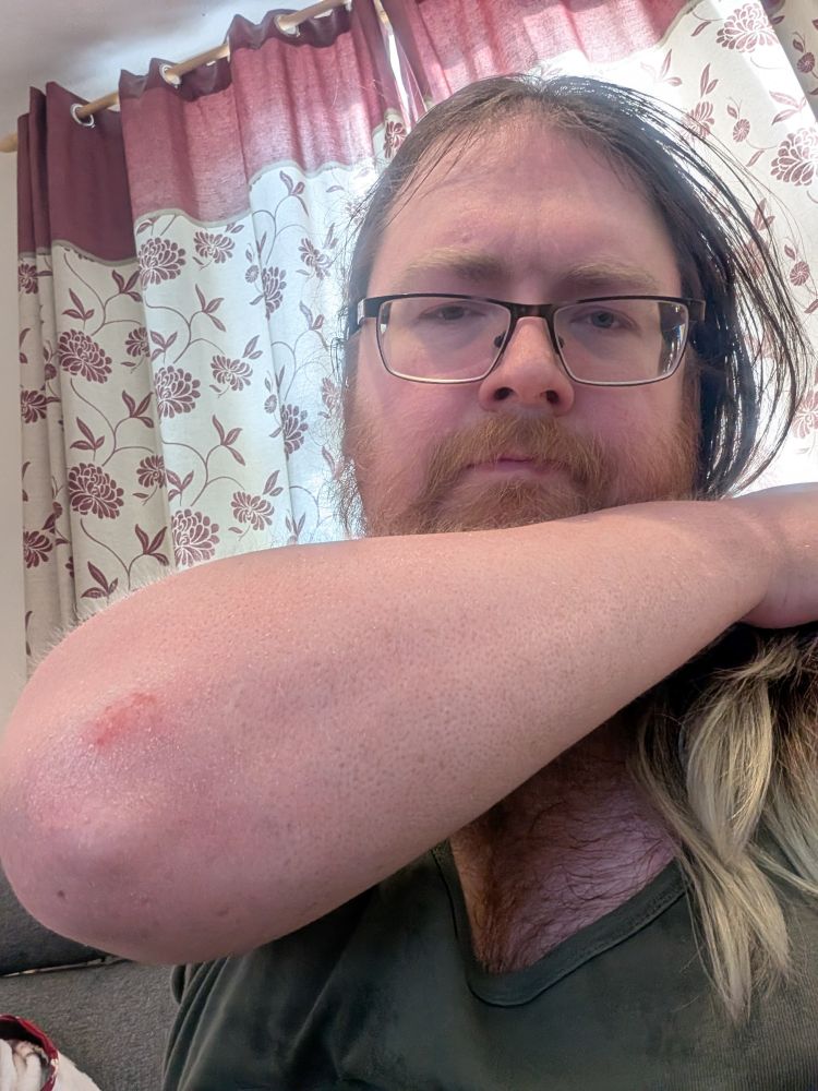 Is a photo of me and my elbow is grazed. You can see my chest if you want.