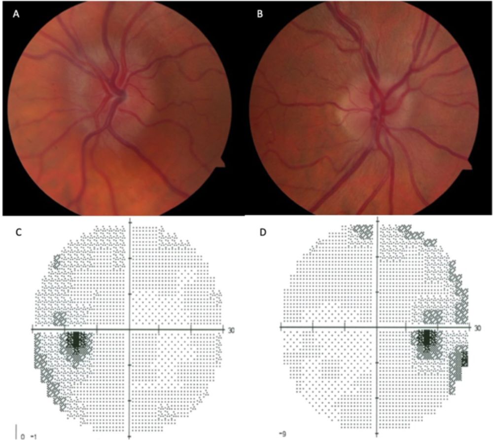 Managing idiopathic intracranial hypertension in the eye clinic - Eye