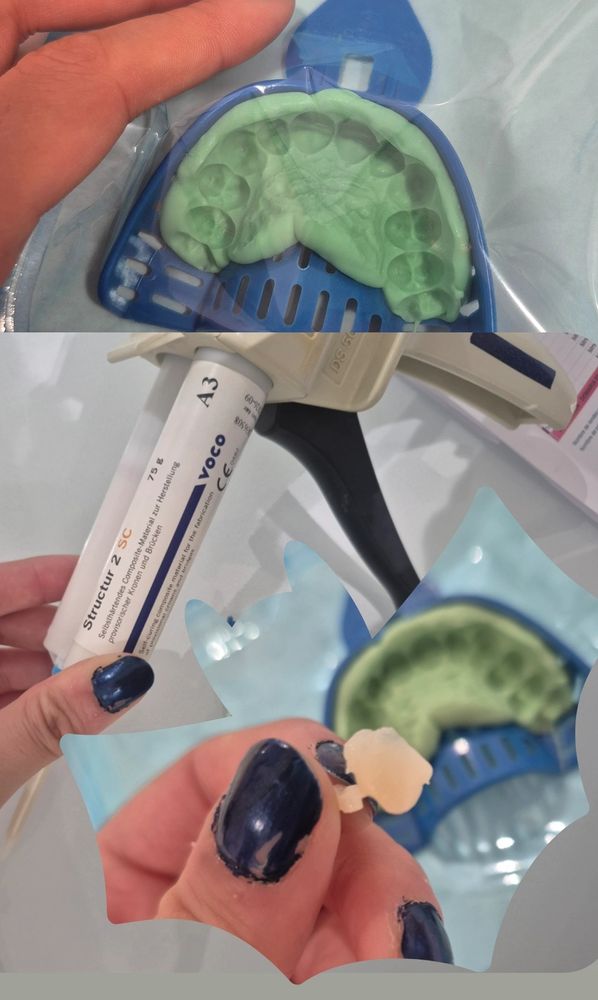 Processus de fabrication de dents de vampire à l'aide d'une empreinte alginate et d'un composite fluide A3.