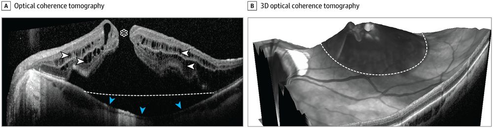 Two grayscale eye scans: A) Optical coherence tomography shows eye structure with white and blue arrows indicating features, labeled. B) 3D optical coherence tomography displays a textured eye surface with a dashed line.
