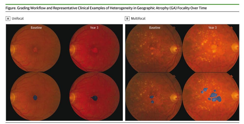 Eye fundus images display Geographic Atrophy (GA) focality over time. 'A' shows unifocal GA at baseline and year 3. 'B' shows multifocal GA at baseline and year 3, with blue areas highlighting atrophy progression.