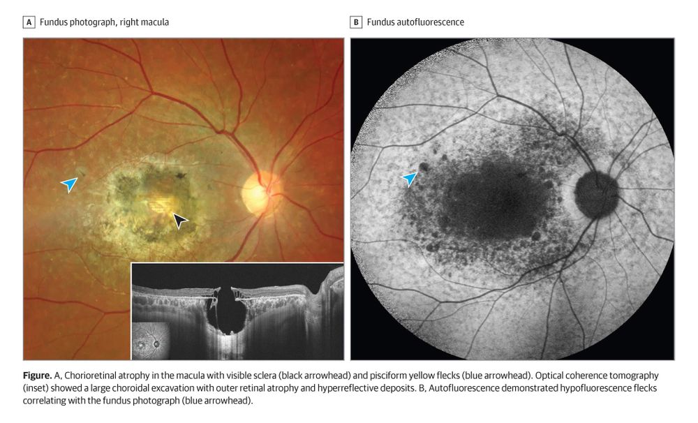 Fundus images: A shows right macula with chorioretinal atrophy, sclera(black arrowhead), and pisciform yellow flecks (blue arrowhead). Inset shows choroidal excavation. B shows fundus autofluorescence with hypofluorescence flecks (blue arrowhead).