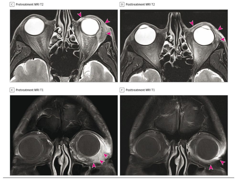 Image shows pretreatment and posttreatment MRI T2 and T1 scans of an eye, with pink arrows indicating changes. Text: 'C Pretreatment MRI T2', 'D Posttreatment MRI T2', 'E Pretreatment MRI T1', 'F Posttreatment MRI T1'.