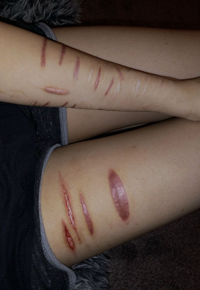 I have more arm scars now but I still need to fill in the gap between my thigh scars someday