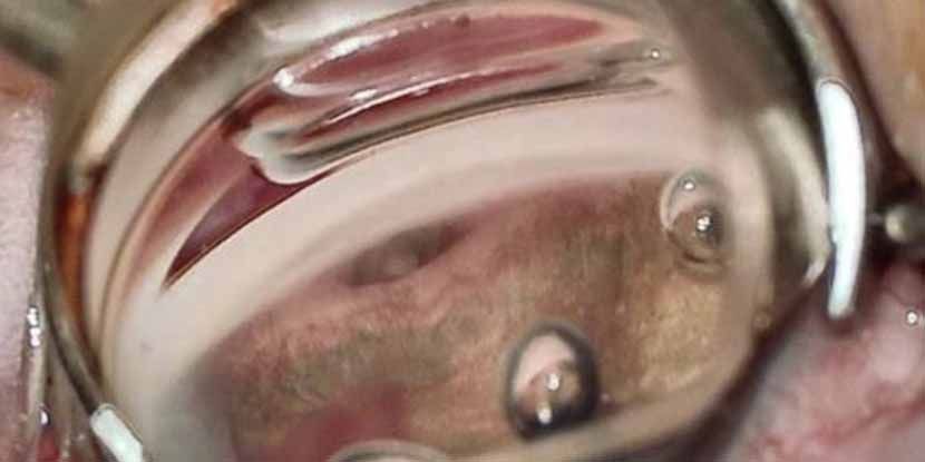 Creating a Stable Cyclodialysis Cleft May Help to Overcome POAG Surgical Limitations