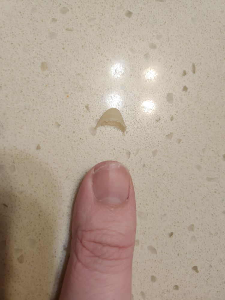 A nicely shaped long thumbnail entirely broken off of a thumb