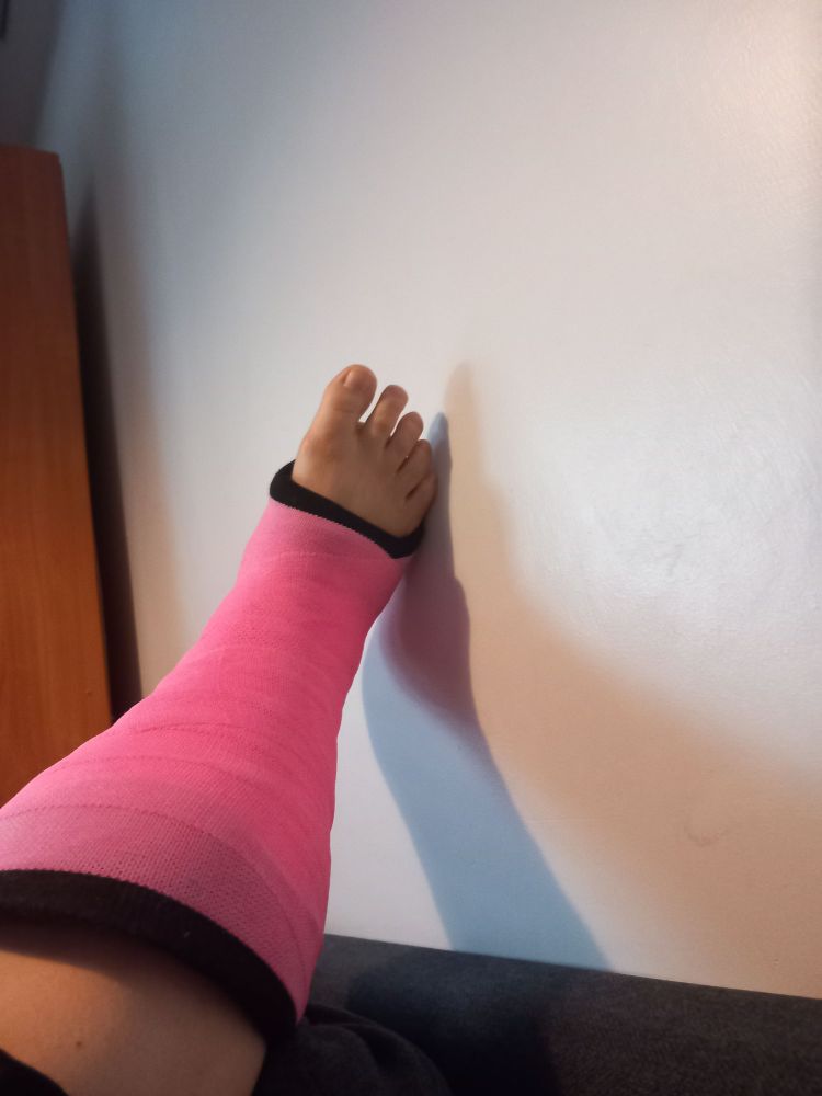 Kuvassa on jalka kohoasennossa kipsattuna 