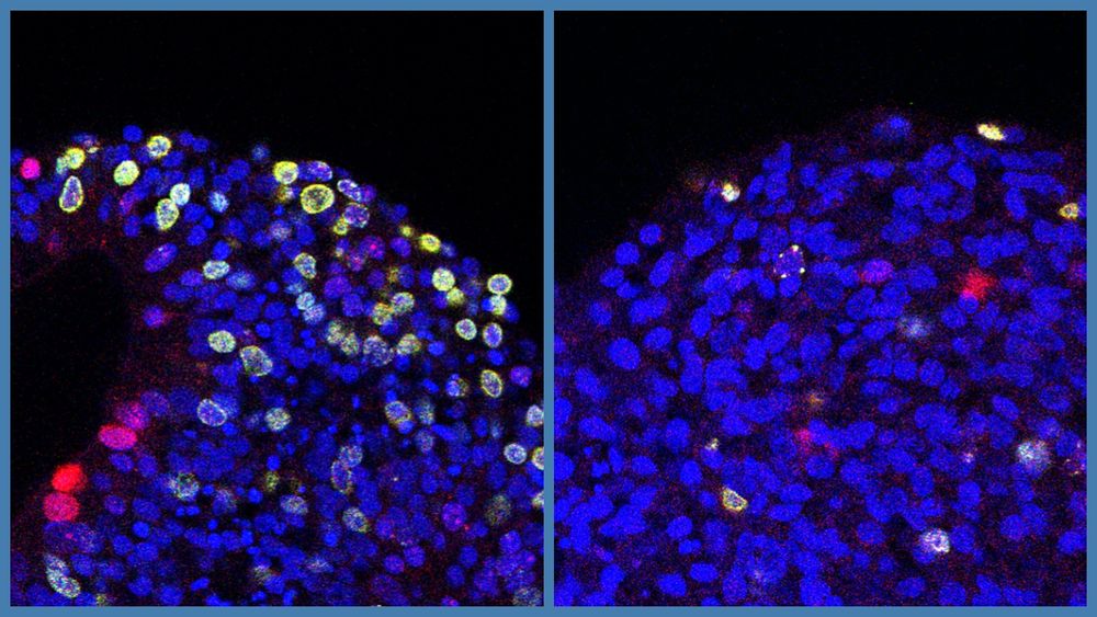 Fluorescent labels reveal that a higher proportion of cells from 22q11.2 deletion syndrome patients (left) are stuck in an early phase of division (green), compared to cells from healthy individuals (right).
