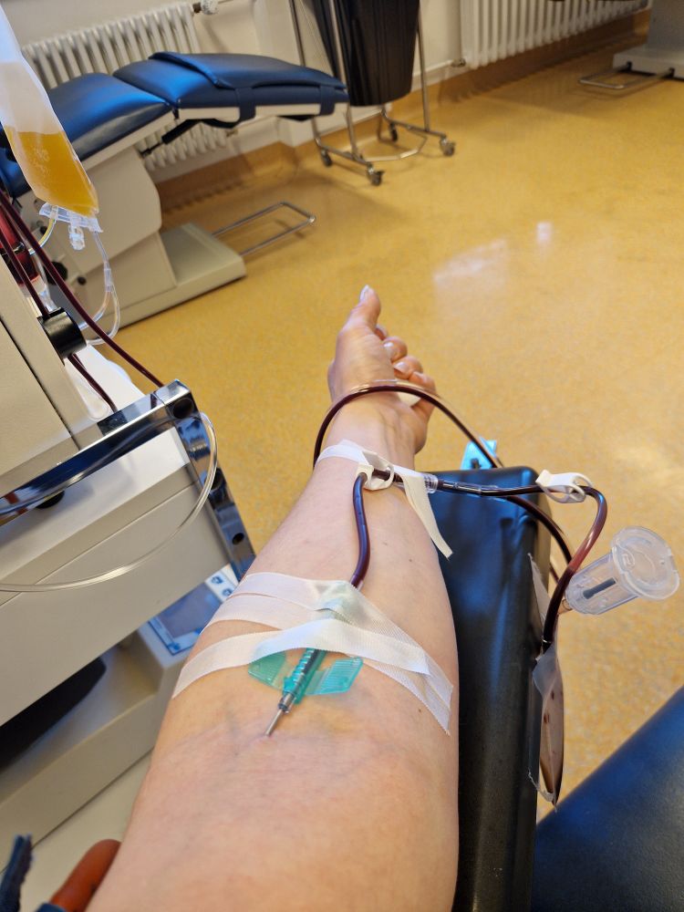 Mein linker Arm mit Punktionsnadel in der Vene bei der Thrombozytenspende 