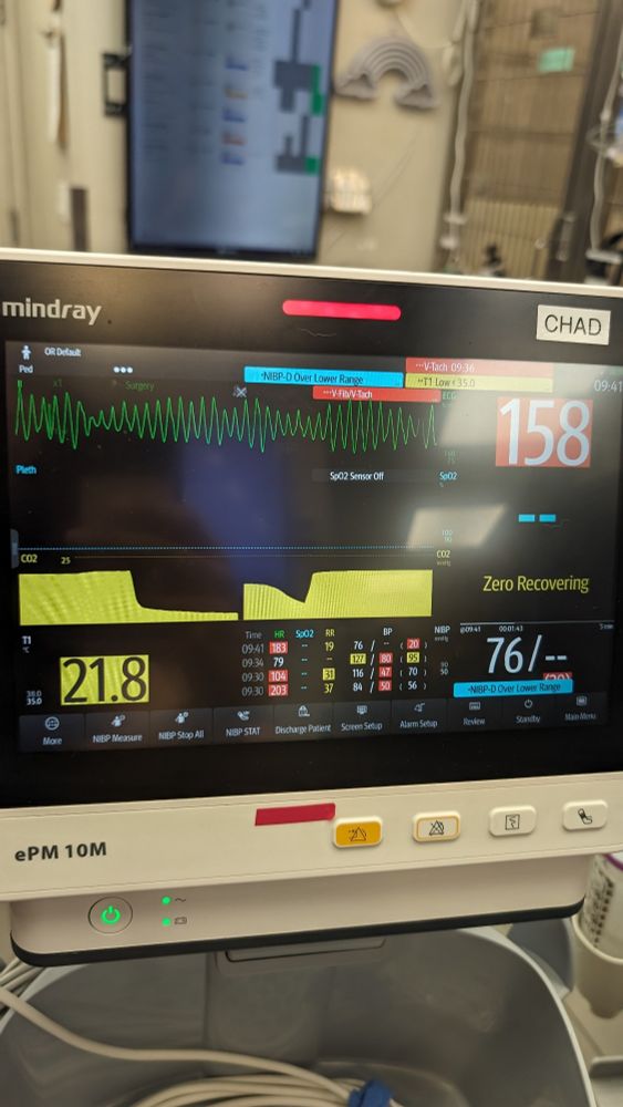 An ECG showing a very nasty arrhythmia that isn't compatible with life