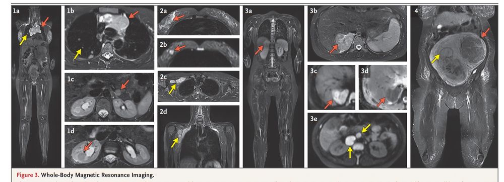 MRI images finding the cancer from an abnormal maternal DNA test
