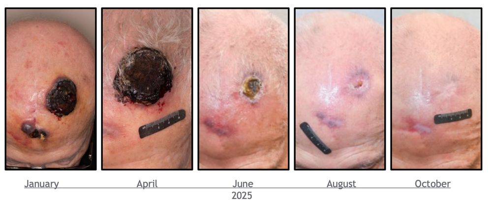 Receding scalp lesion shown in photographs