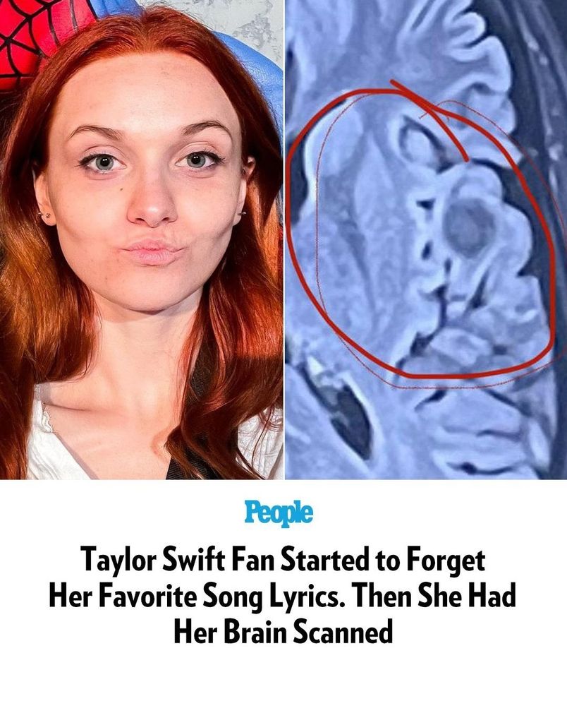 photo of a red-haired girl side by side with a scan of her brain, zoomed in with a red circle around a brain tumor. the text reads: "taylor swift fan started to forget her favorite song lyrics. then she had her brain scanned."