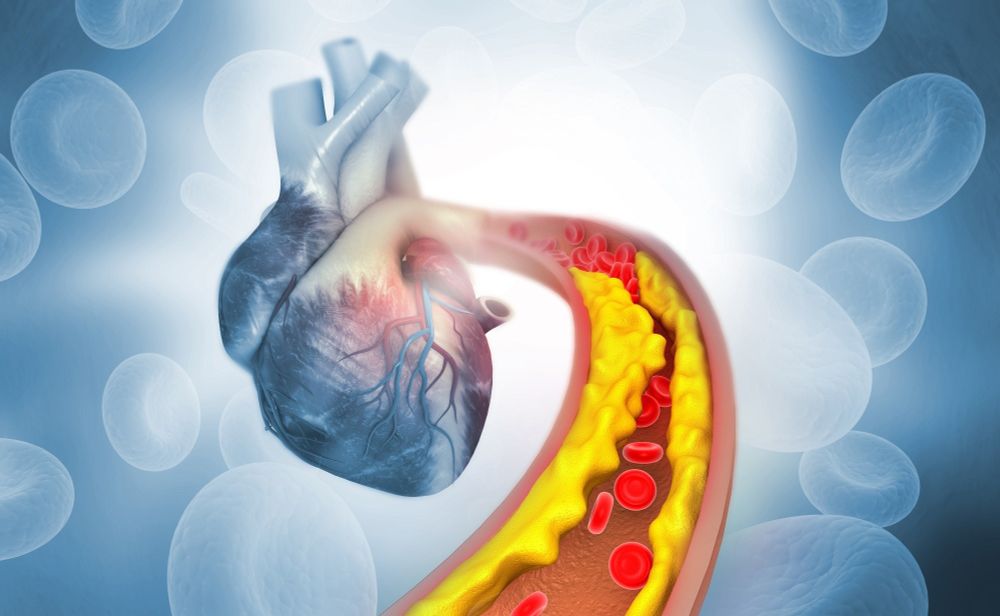 Clonal hematopoiesis drives femoral atherosclerosis in middle-aged adults