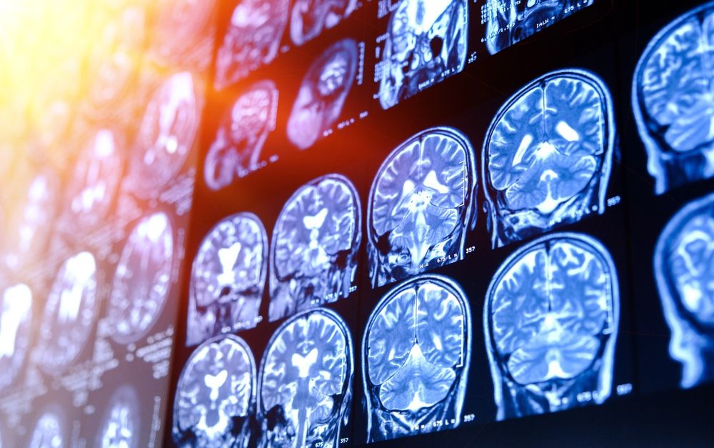 Neuroactive drugs show promising anti-glioblastoma effects in preclinical trials