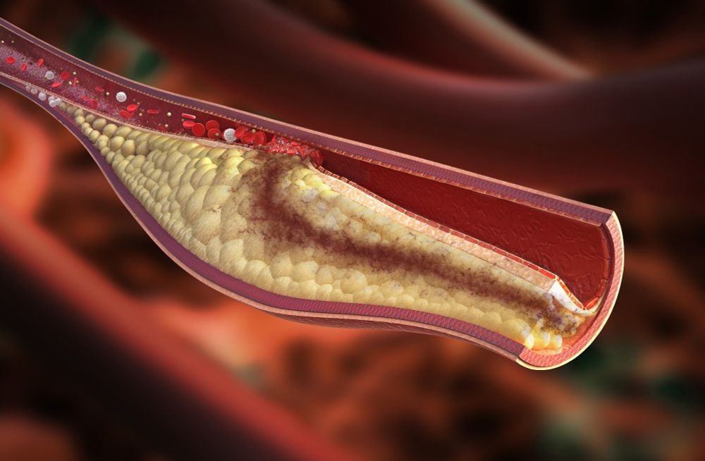 Alirocumab reduces dangerous coronary plaque and stabilizes high-risk lesions