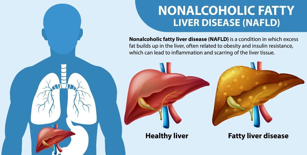 Higher soft drink consumption linked to increased risk of liver disease