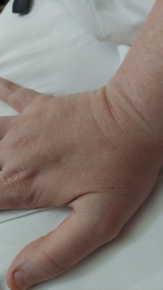 The right hand is a little less red than before