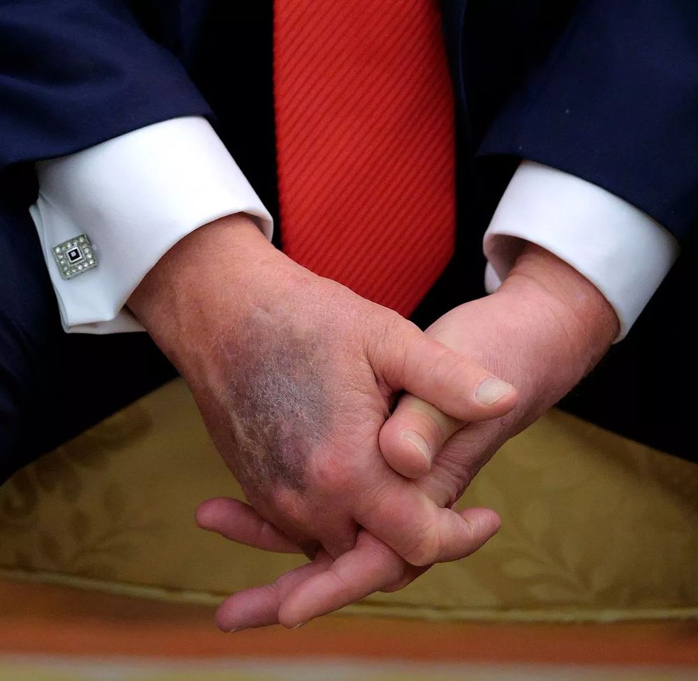 A photo of Trump's clasped hands which are heavily bruised