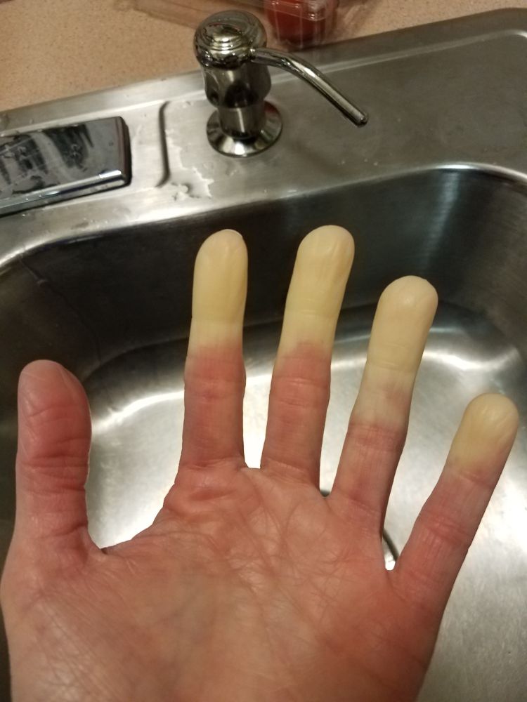 Hand with white fingertips. Blood vessels have malfunctioned and restricted blood flow to the fingertips. The rest of the hand has normal coloring.