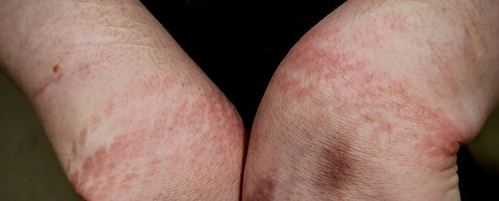 The aftermath of the bondage showing indent where the rope gripped. The sub enjoyed this very much. Also the bruises where already there