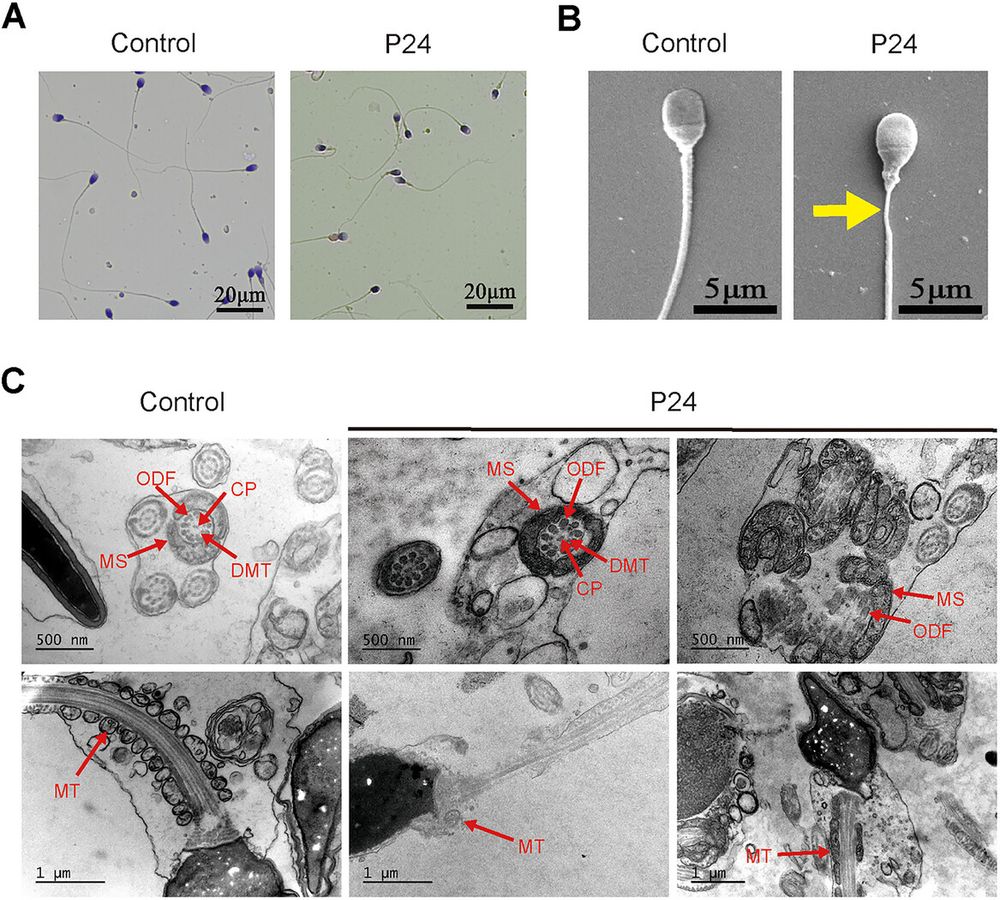 Figure 2: Morphology and ultrastructure analysis of spermatozoa in the fertile male and the man harbouring CFAP74 variants. (A) Morphology analysis of the spermatozoa from a fertile man and the proband P24 by modified Papanicolaou staining. (B) SEM analysis of spermatozoa cells from a control individual and the proband P24. The thinner midpiece was marked with a yellow arrow. (C) TEM analysis of spermatozoa ultrastructure. A cross section of sperm from a control participant displayed the typical ‘9 + 2’ microtubule structure with CP, nine pairs of peripheral DMT and an arrangement of ODF. Longitudinal section of the control participant displayed organized MS in flagella. Compared with the control, abnormal sperm ultrastructure could be observed in the proband P24. CP, central pair; DMT, doublet microtubule; MS, mitochondrial sheaths; MT, mitochondria; ODF, outer dense fibre; SEM, scanning electron microscopy; TEM, transmission electron microscopy.