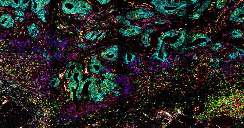 Winner of the Danish Bioimaging Microscopy Image Contest 2024. Multiplex staining of colon cancer. Imaged by Xiang Zheng, NNF Center for Protein Research, Københavns Universitet - University of Copenhagen.