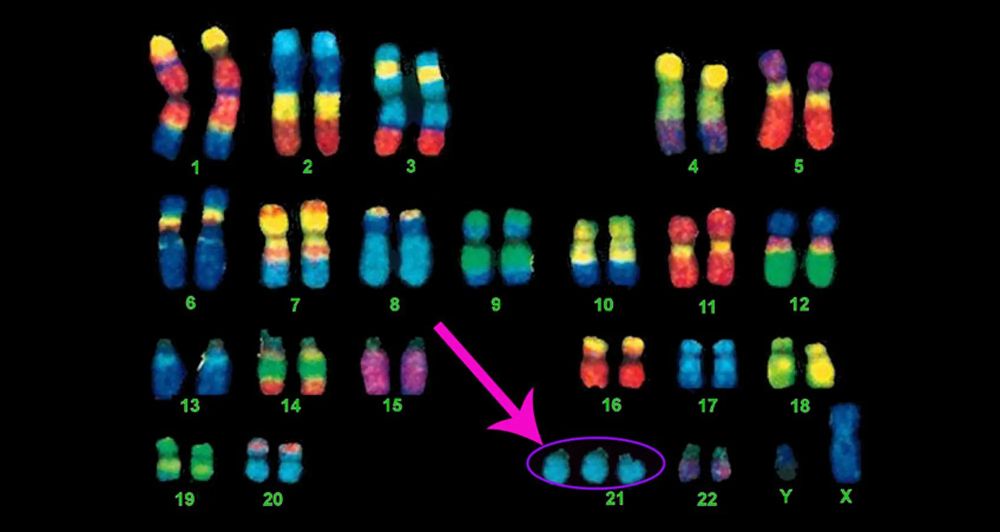 In this colorized karyotype of chromosomes, the three copies of chromosome 21 are indicated. Trisomy 21 causes Down syndrome, and half of all such cases also involve congenital heart defects.