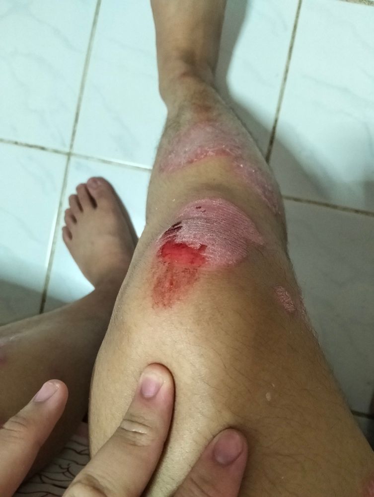 Close-up of my right knee with a scraped wound. The wound is reddish, slightly bloody, and surrounded by dry, peeling skin. My left hand is lightly touching the leg.