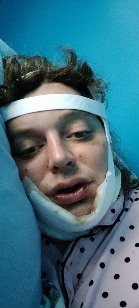 Day 2 healing from lower ffa