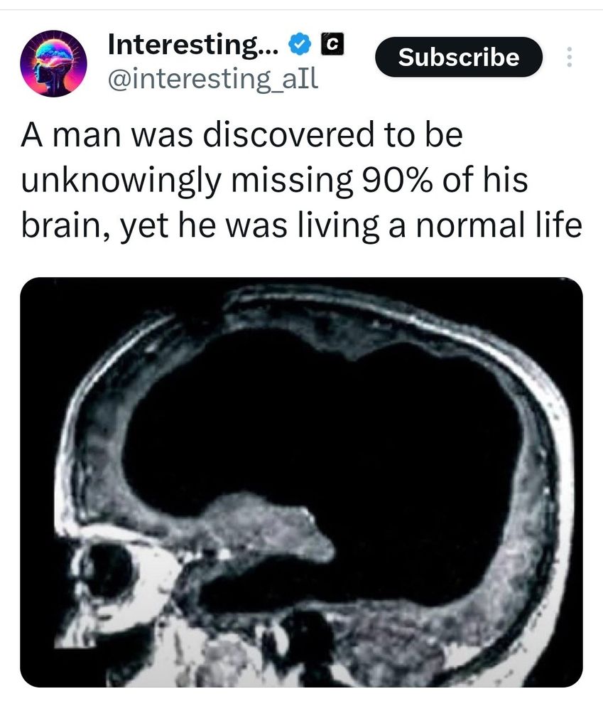 Post stating "A man was discovered to be unknowingly missing 90% of his brain, yet he was living a normal life"
