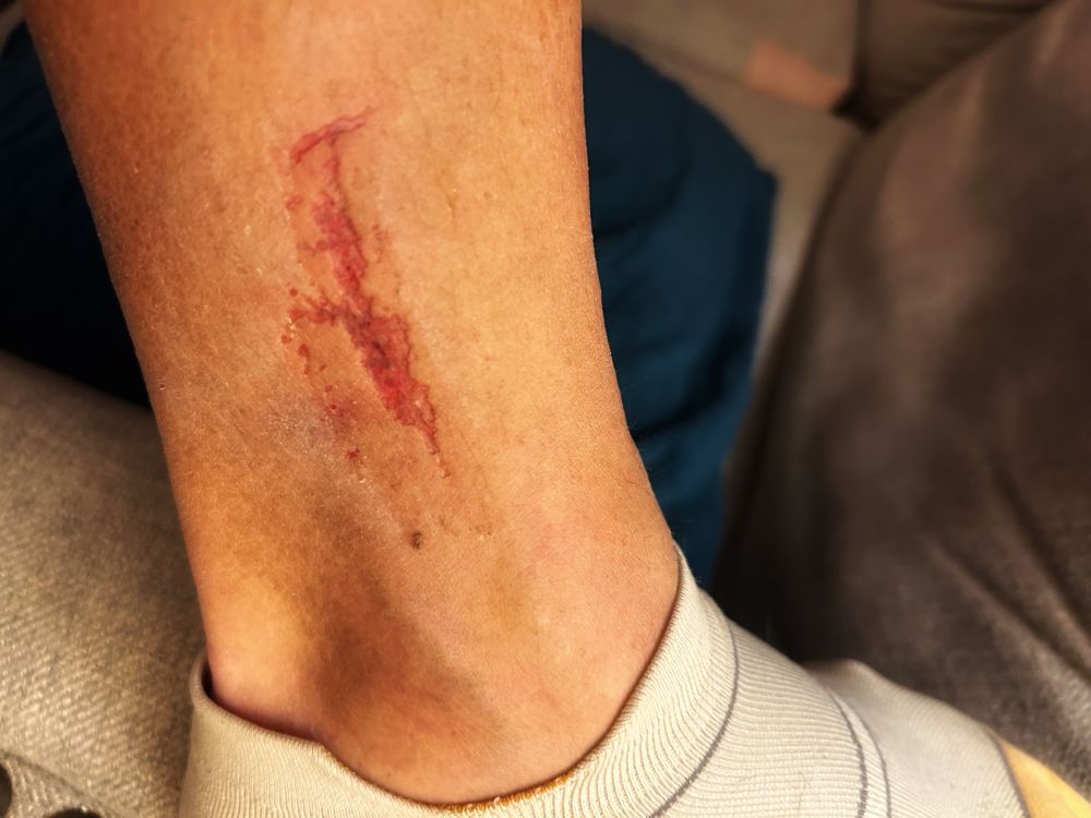 Superficial scrape on right ankle.