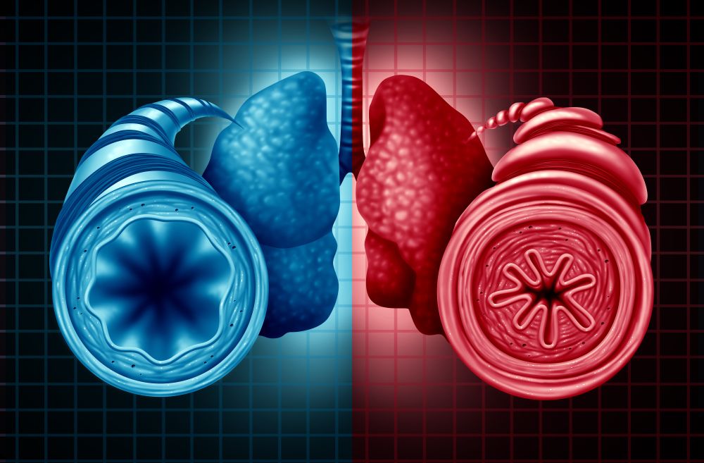 
Illustration comparing two airways. The left side shows a healthy airway in blue with a clear, open passage. The right side depicts an inflamed, constricted airway in red with a narrowed passage, indicating inflammation or obstruction. The background features a grid pattern.