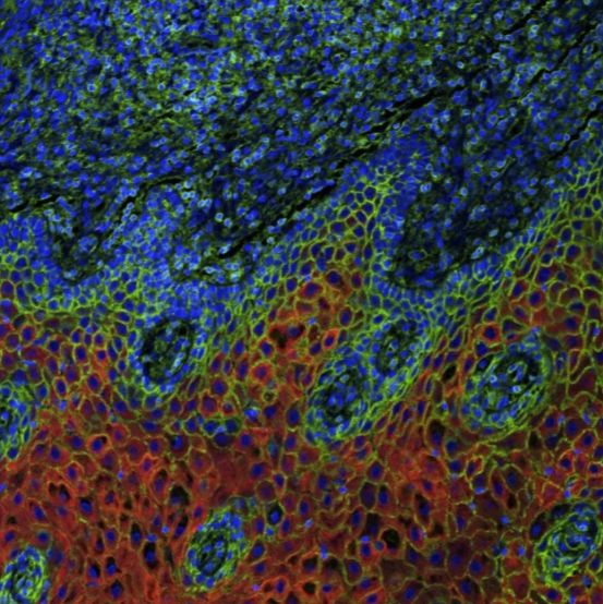 Cancer cells, shown in red, prevent the presentation of antigens, shown in green, and evade T cells, which kill cancer cells as a part of the body’s immune system. Image courtesy of Lexi Vu in the Pyeon lab at Michigan State University.
