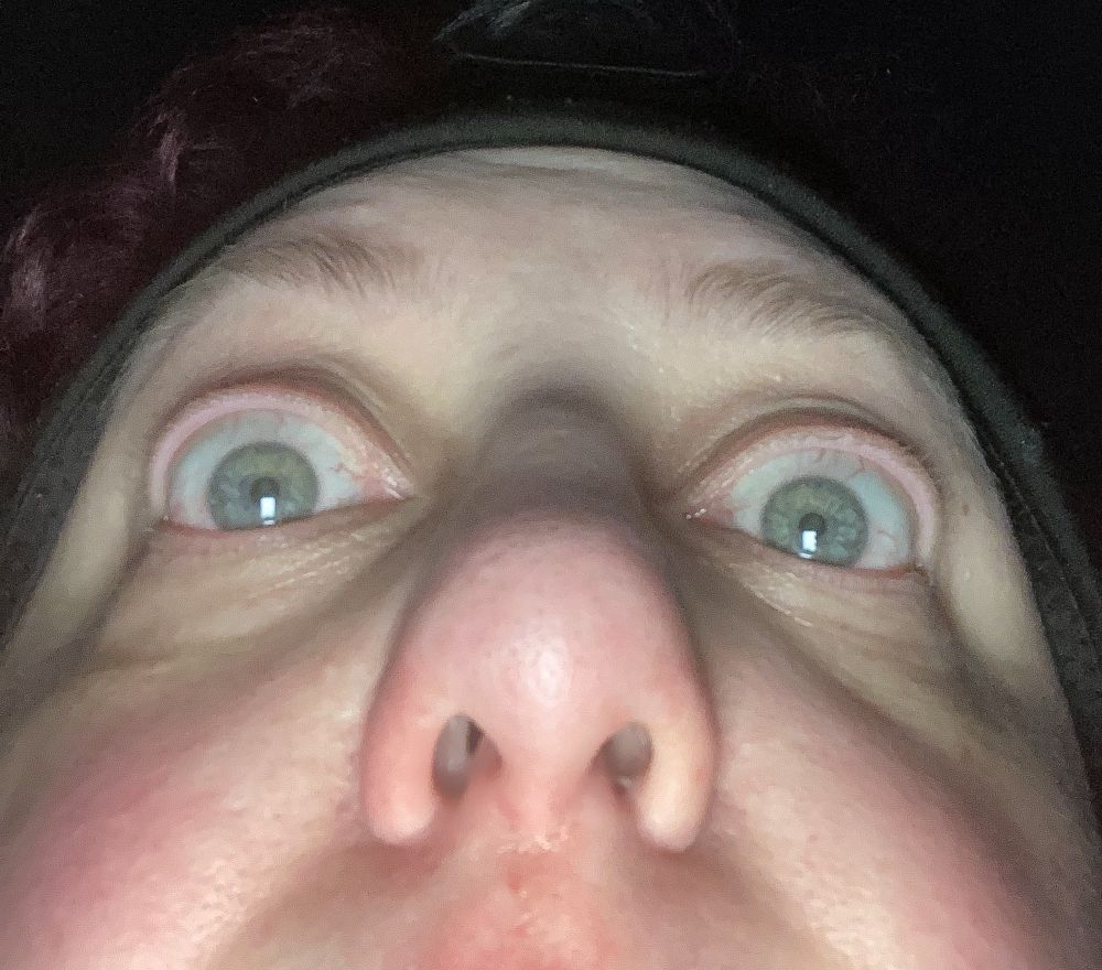 An extreme closeup of my eyes and especially my infected nose, in the style of the Blair Witch Project