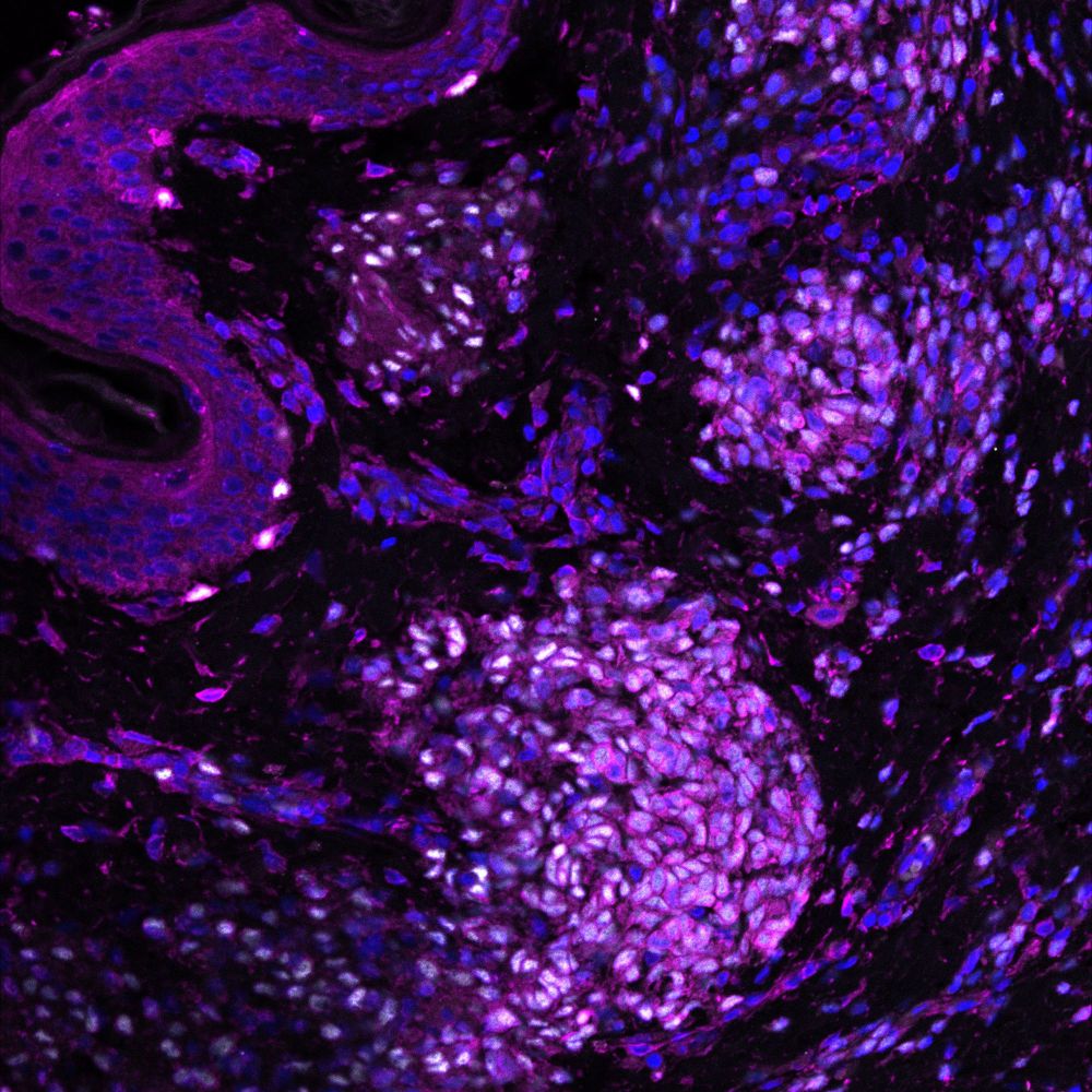 Representative image of a large congenital melanocytic nevus stained with antibodies against SPTBN1 (purple) and SOX10 (white), a known melanocyte marker. Epidermal melanocytes (top left corner) and dermal melanocytes (round cell clusters) co-express SPTNB1 and SOX10. Nuclei are counterstained with DAPI (blue), which stains the genomic DNA.