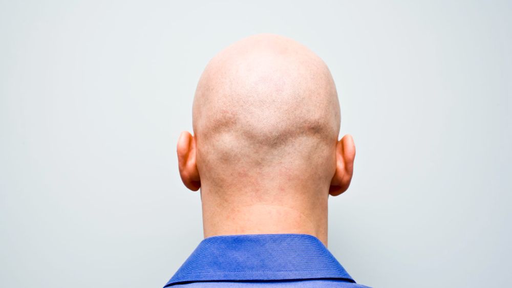 Calling a man "bald" is now classed as sexual harassment, a judge in a U.K. employment tribunal has ruled.